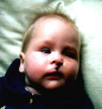 Maike 4 Tage nach OP