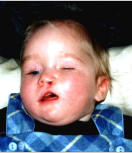 Maike 2 Wochen nach OP