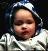 Maike 4 Monate nach OP